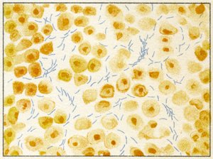 Tuberculosis Bacteria in Sputum by German School